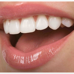 MICRODISEÑO DE SONRISA